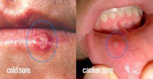 A Sore Canker Is Herpes