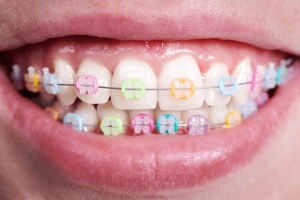 Ceramic Braces used for Orthodontic Treatment