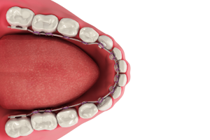 Lingual Braces used for Orthodontic Treatment