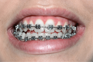 Traditional Braces used for Orthodontic Treatment