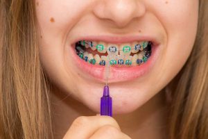 Young lady cleaning braces using an interdental toothbrush.