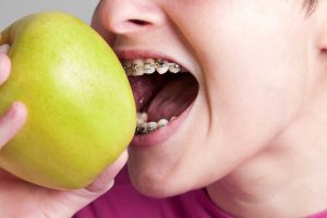 Woman with braces eating an apple.