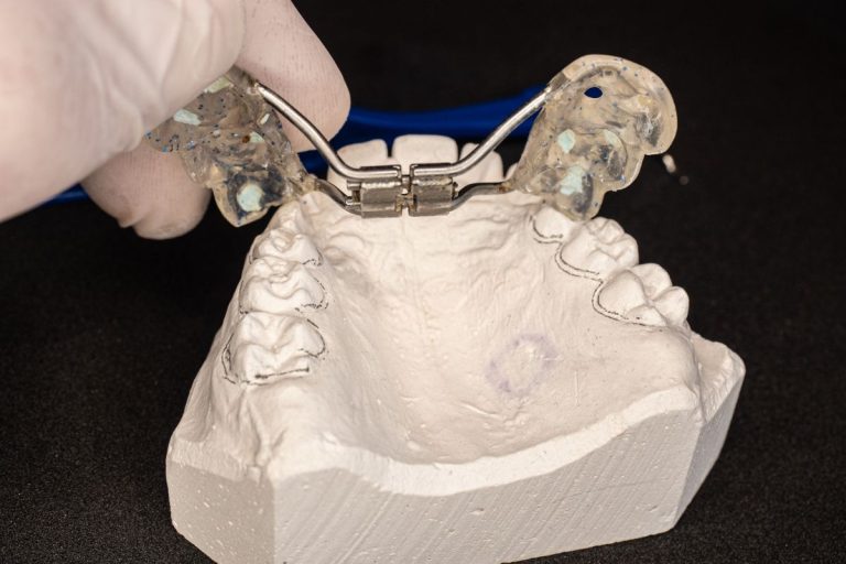 Understanding Palatal Expanders Benefits, Types, and More Orthodontist Toronto Invisalign