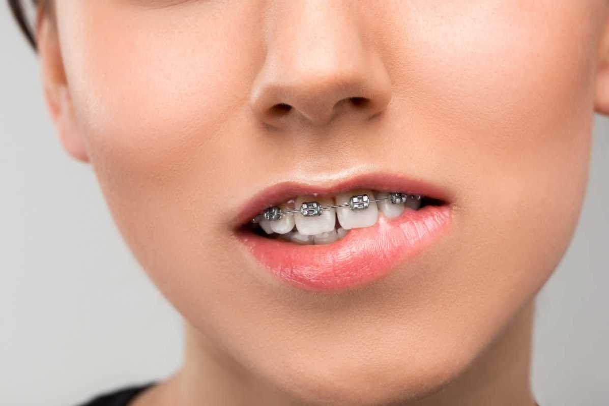 The Best Orthodontic Treatment Options for Overbite Orthodontist