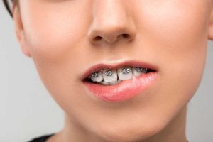 The Best Orthodontic Treatment Options for Overbite