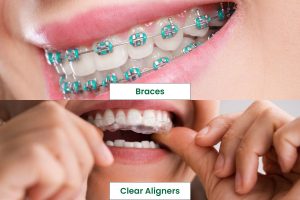 purple and teal braces