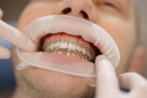 Orthodontic Banding or Orthodontic Bonding