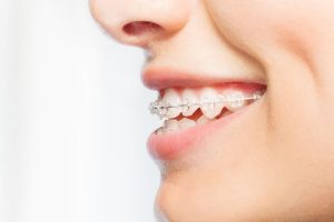 Difference between overjet and overbite