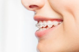 Blog - Orthodontist Toronto, Invisalign Provider