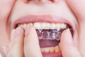 How long does clear aligner treatment take?