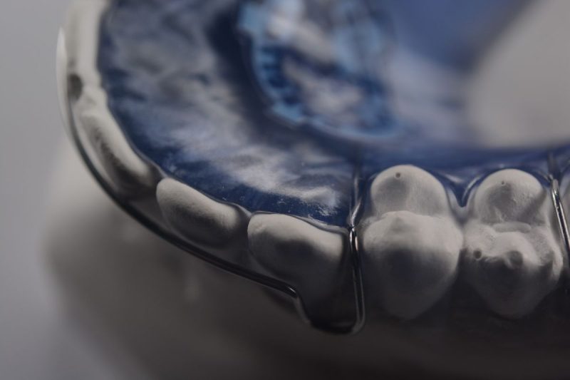 Hawley Retainers Everything You Need To Know Orthodontist Toronto