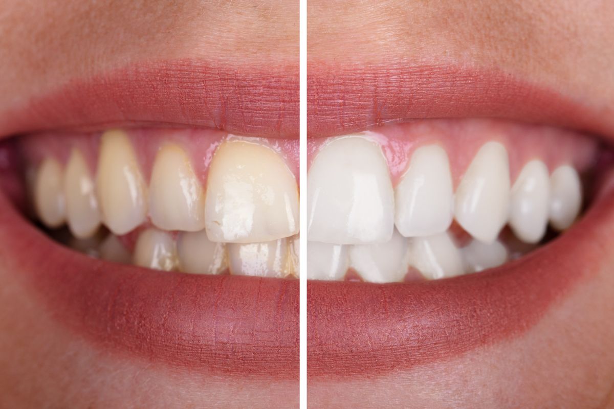 Can You Whiten Teeth with Braces On? Orthodontist Toronto