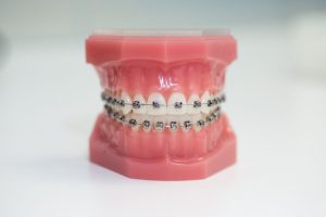 What are self-ligating braces?